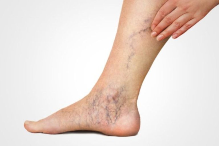 Varicose Veins