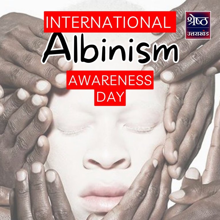 International Albinism Awareness Day 2024